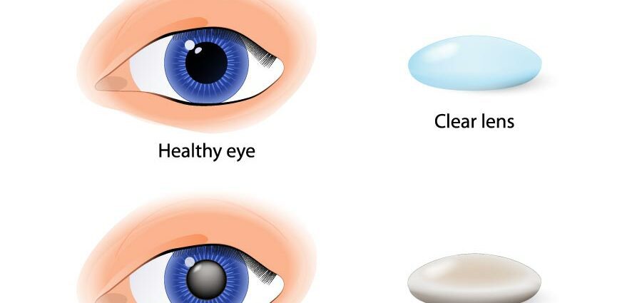 Predispositions to cataracts