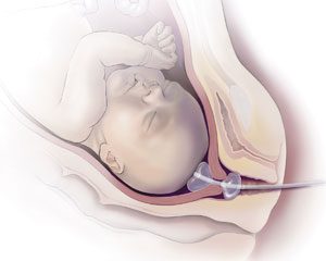 Terhességi ballon: mire való, miért kell használni?