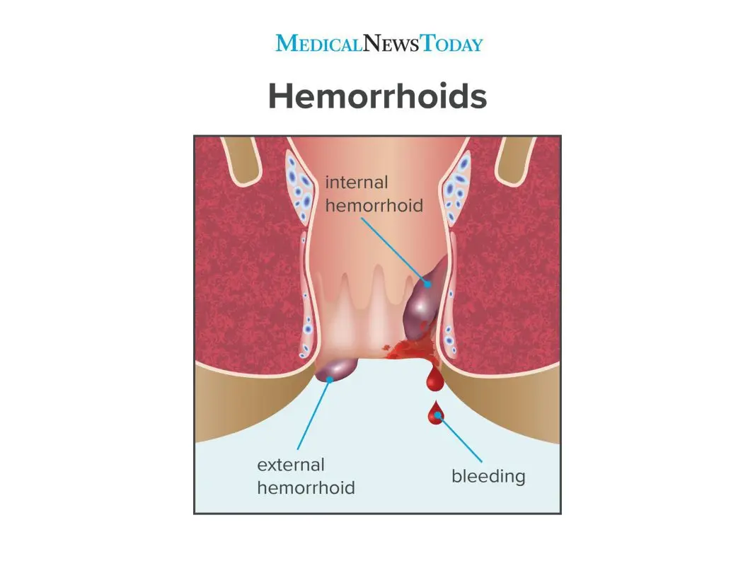 Pregnancy hemorrhoids