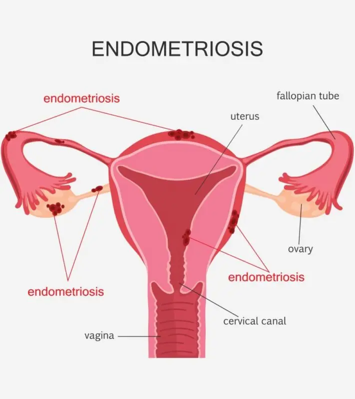 Pregnancy with endometritis, endometritis during pregnancy