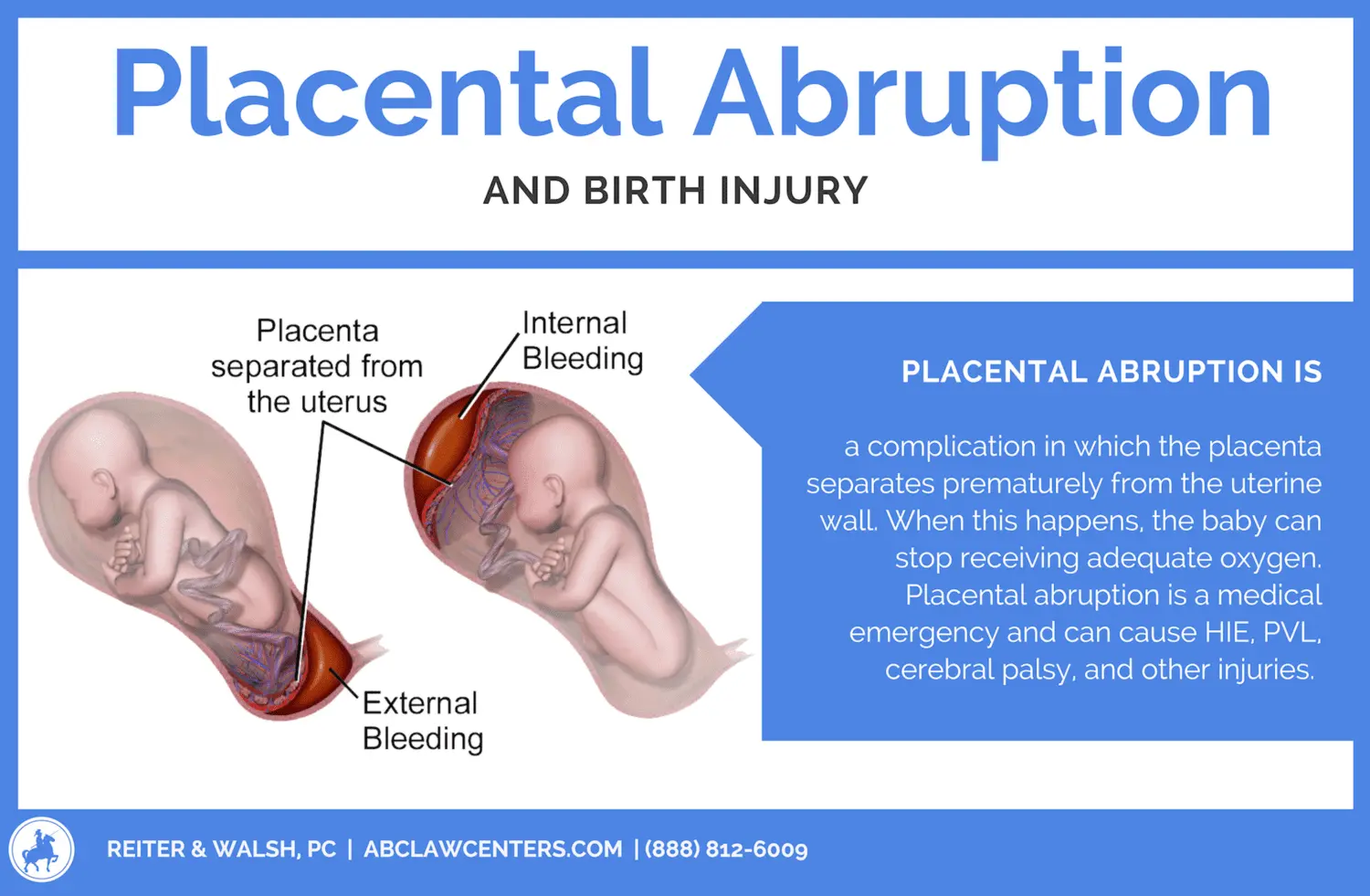 Premature placental abruption: what you need to know? Video