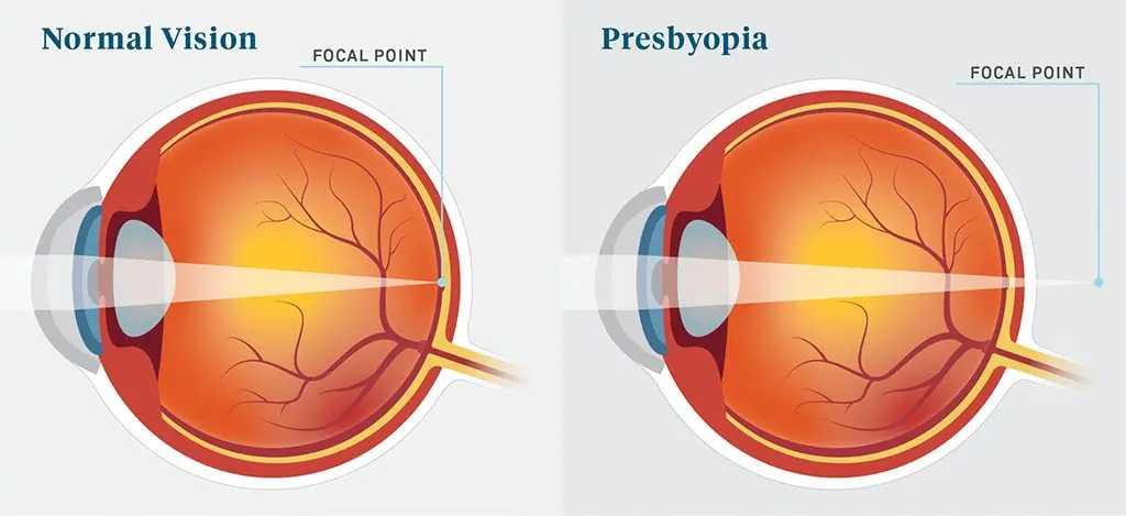 Presbyopia