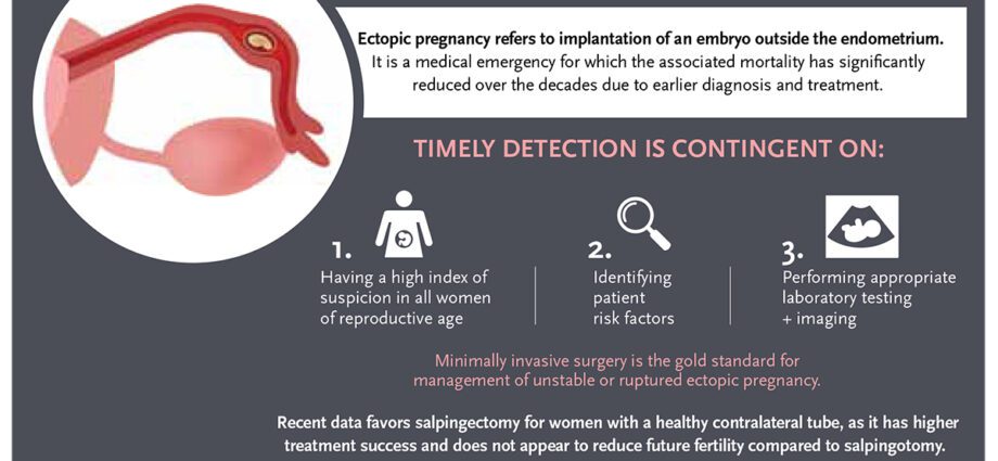 Prevenzione è trattamentu medicu di a gravidanza ectopica
