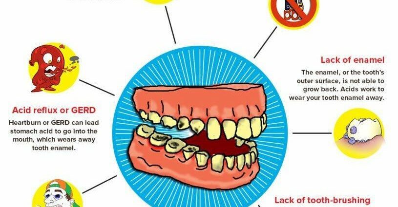 Prevention and treatment of cavities