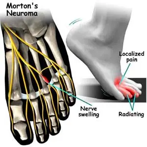 Prevention and treatment of Morton&#8217;s disease