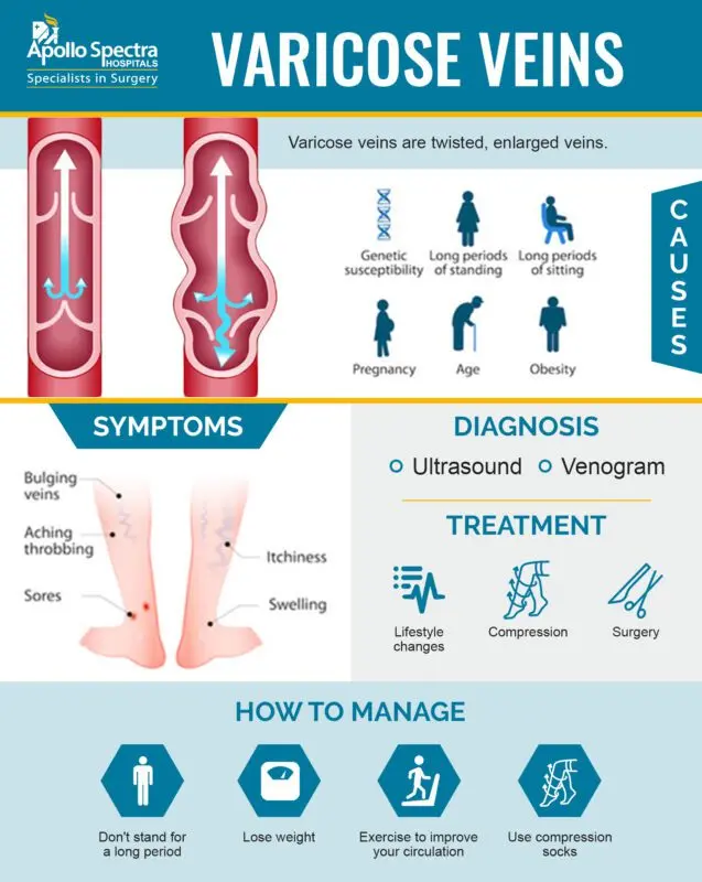 Prevention and treatment of varicose veins of the legs