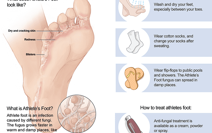 Athlete&#8217;s foot &#8211; Sites of interest