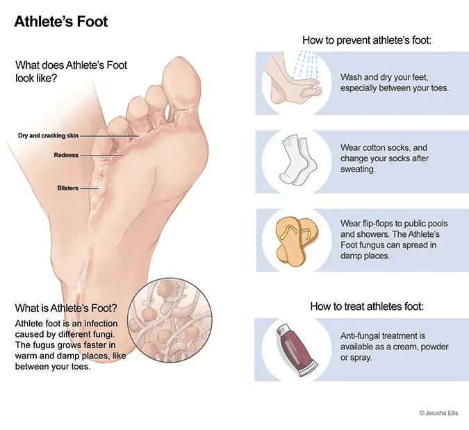 Athlete&#8217;s foot &#8211; Sites of interest