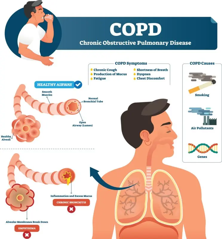 Medical treatments for chronic bronchitis and emphysema (COPD)