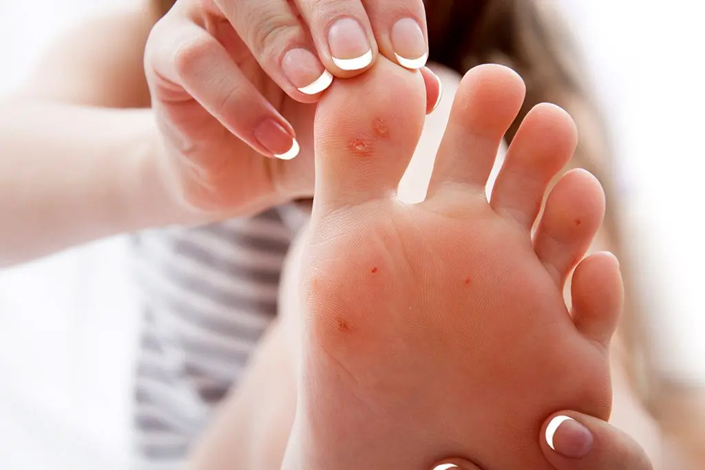 Prevention of common and plantar warts