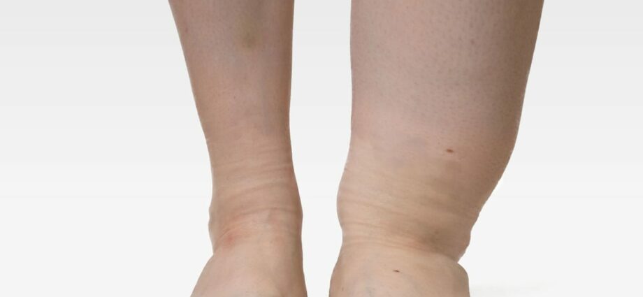 Prevenção de edema das pernas