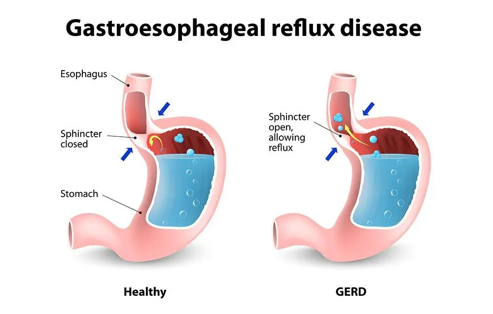 Prevention of gastroesophageal reflux disease (heartburn)