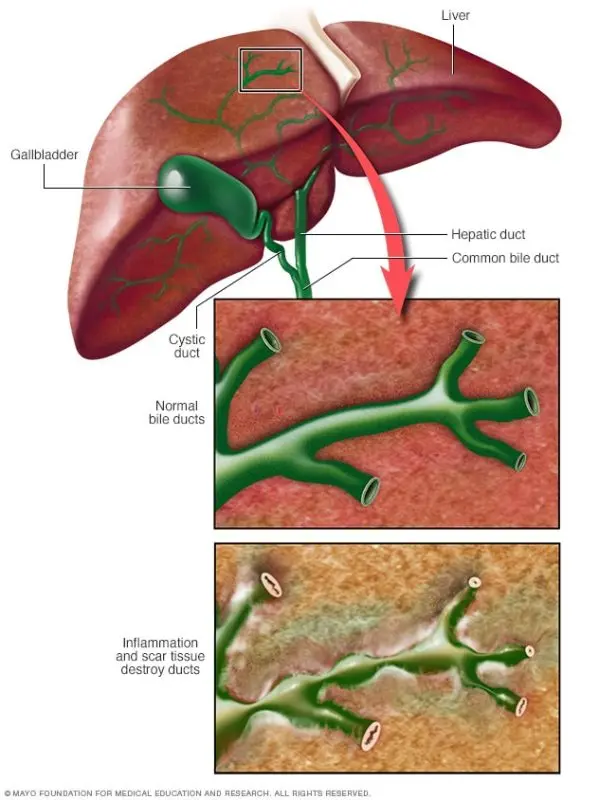 Primary biliary cirrhosis