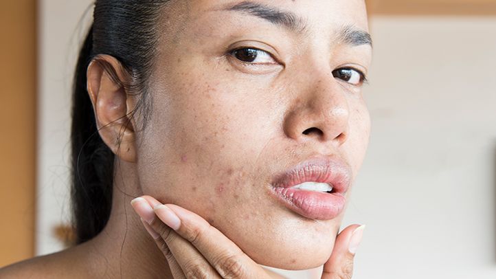 Problem skin: how to get rid of acne? Video