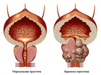 Prostate adenoma: mafuaʻaga, faʻailoga ma togafitiga