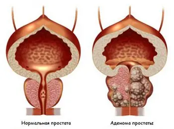 Prostate adenoma: causes, symptoms and treatments