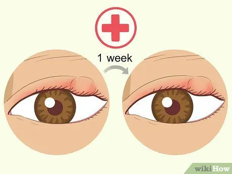 Puffy eyelids: how to make an eye mask? Video