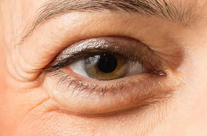 Puffy eyes: causes and ways to deal with the problem
