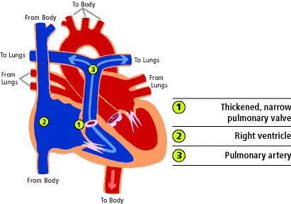 Pulmonary artery stenosis in newborns &#8211; heart defect