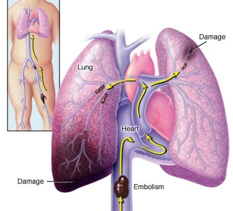 Pljučna embolija