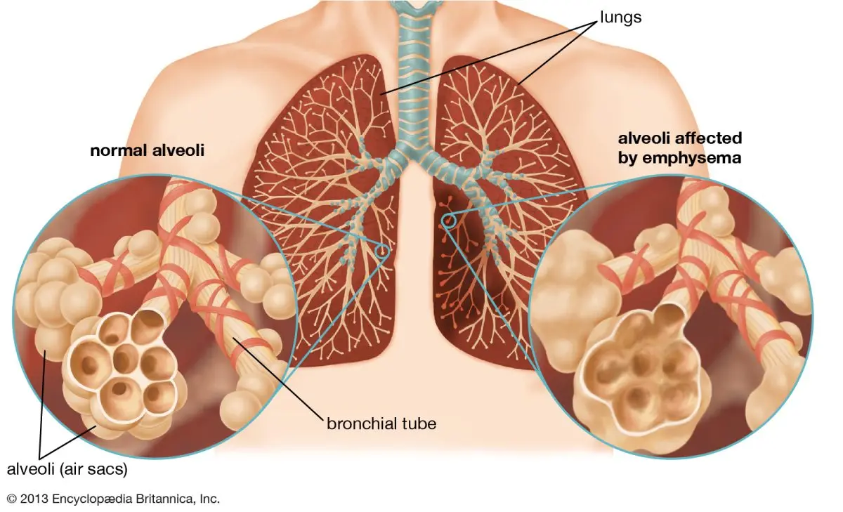 Pulmonary emphysema