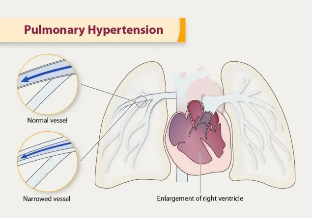 Pulmonary hypertension