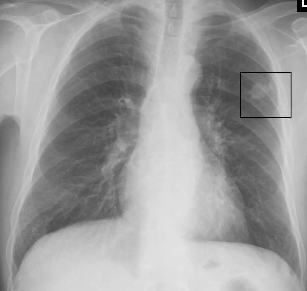 Pulmonary nodule