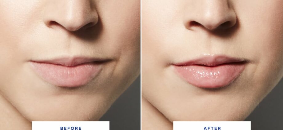 Napuhane usne prije i poslije, fotografija