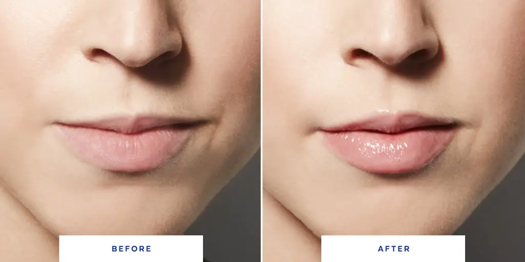 Pumped lips before and after, photo