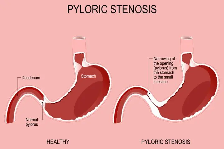 Pyloric stenosis, the second cause of vomiting in babies after GERD