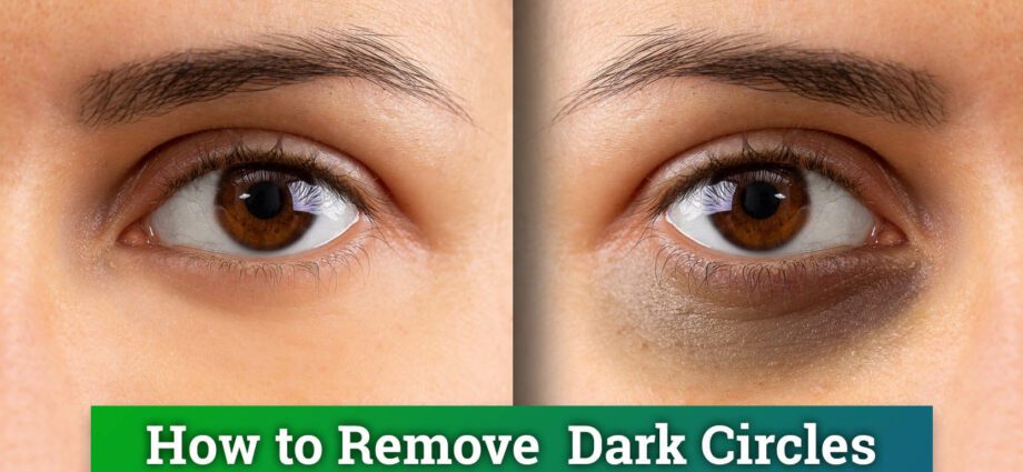 Quickly remove dark circles under the eyes