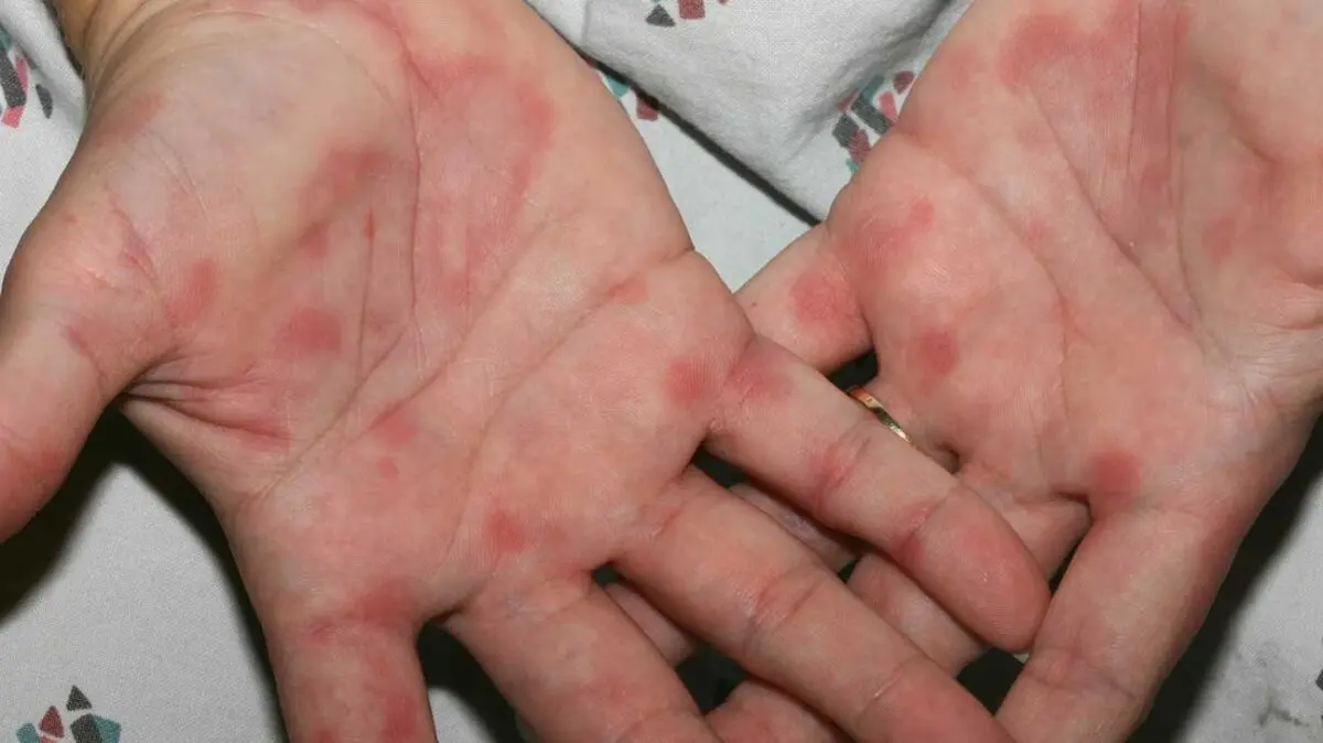 Rash on the palms and feet of a child: causes, allergies