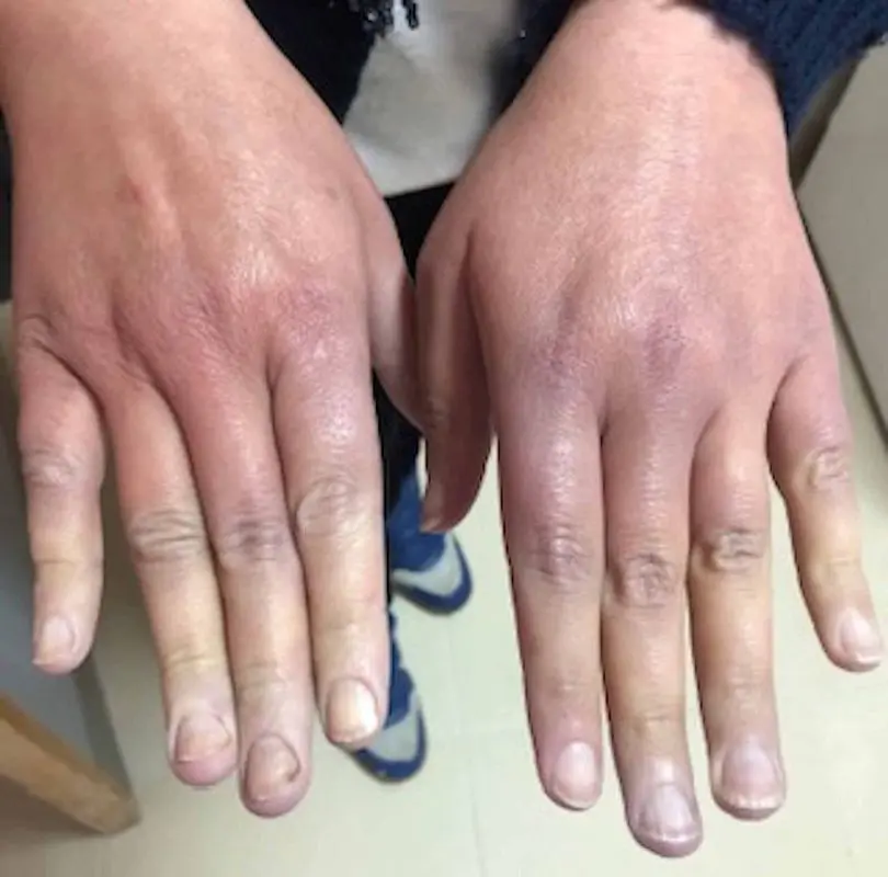 Raynaud&#8217;s disease &#8211; Complementary approaches