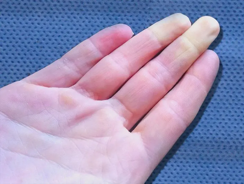 Raynaud&#8217;s disease &#8211; Sites of interest
