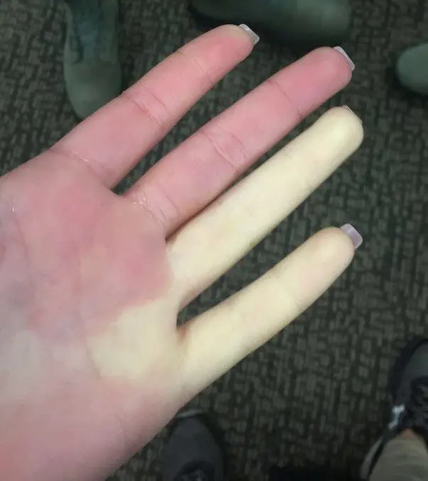 Raynaud&#8217;s disease