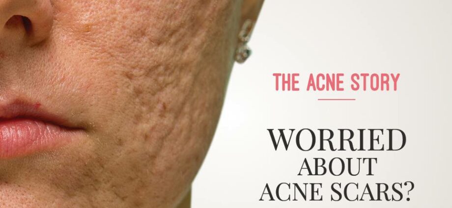 Red acne spots: skin regeneration. Video