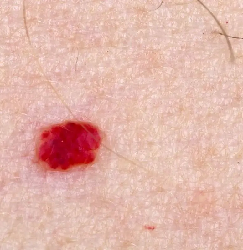 Red dots on the body, hemangioma: causes and methods of treatment, video