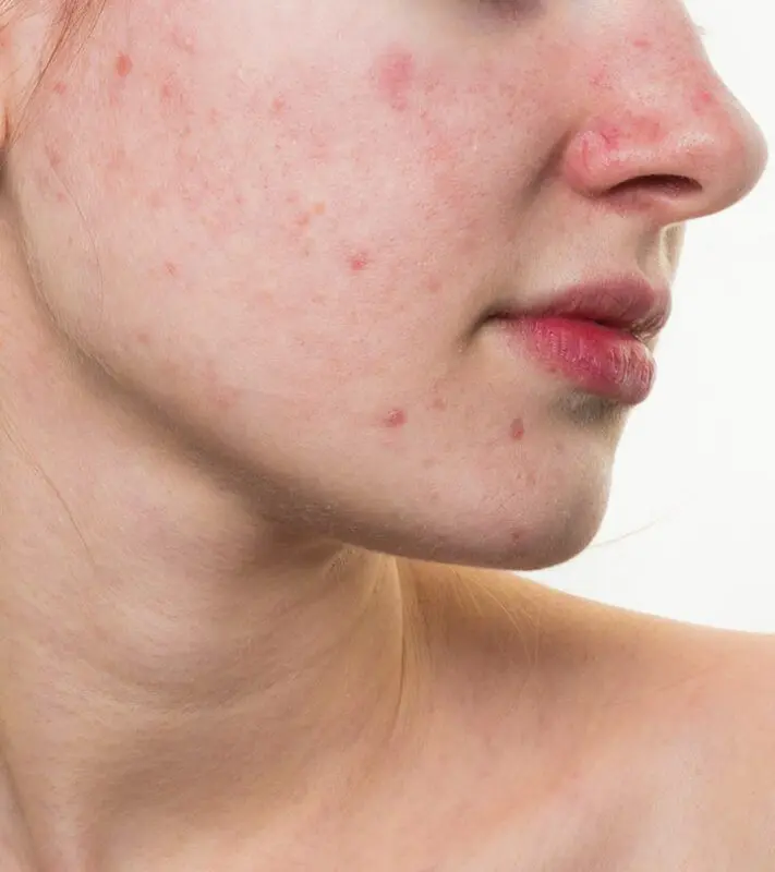 Red spots on the face: how to get old? Video