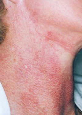 Rote Flecken am Hals: Behandlung mit Volksheilmitteln. Video
