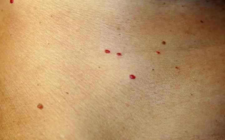 Red spots on the skin: how to get rid of them? Video