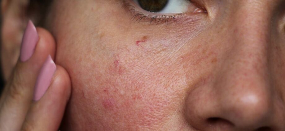 Red vessels on the face: how to get rid of rosacea? Video