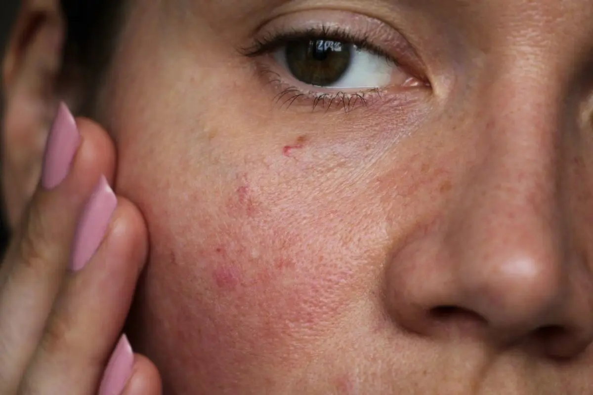 Red vessels on the face: how to get rid of rosacea? Video