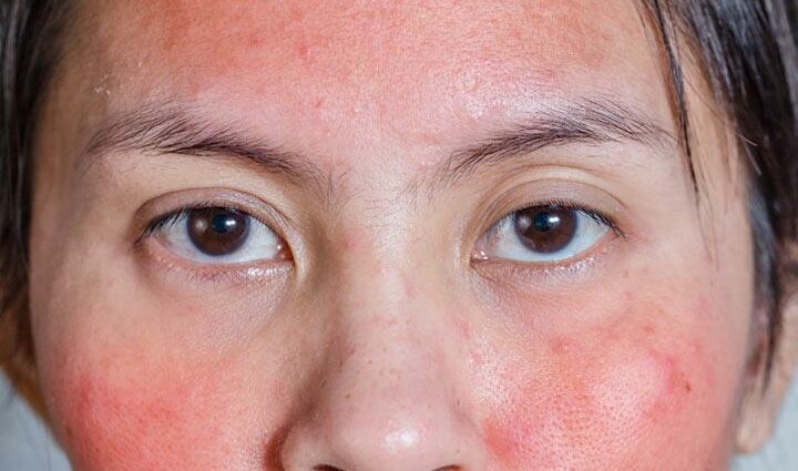 Redness in the face, what are the causes?