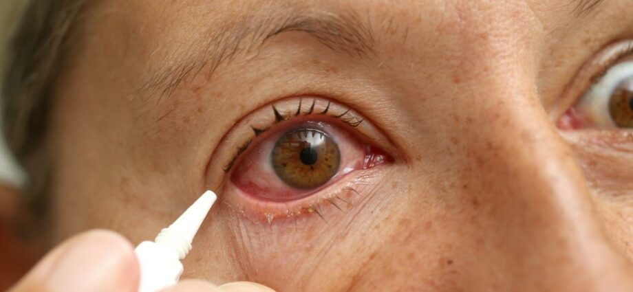 Redness of the eyes: causes and methods of elimination. Video