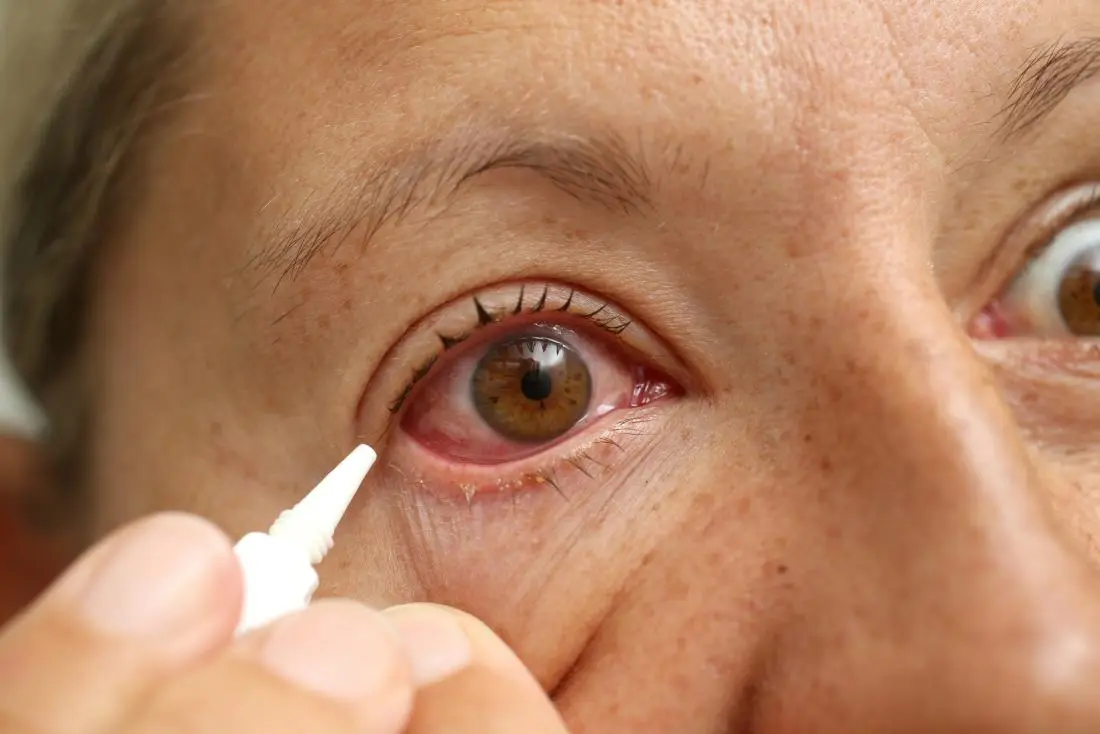 Redness of the eyes: causes and methods of elimination. Video