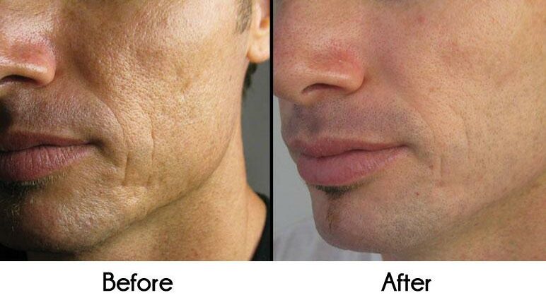 Rejuvenating facial treatments for men