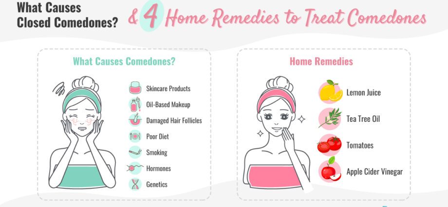 Remedies for comedones: what will help get rid of blackheads forever