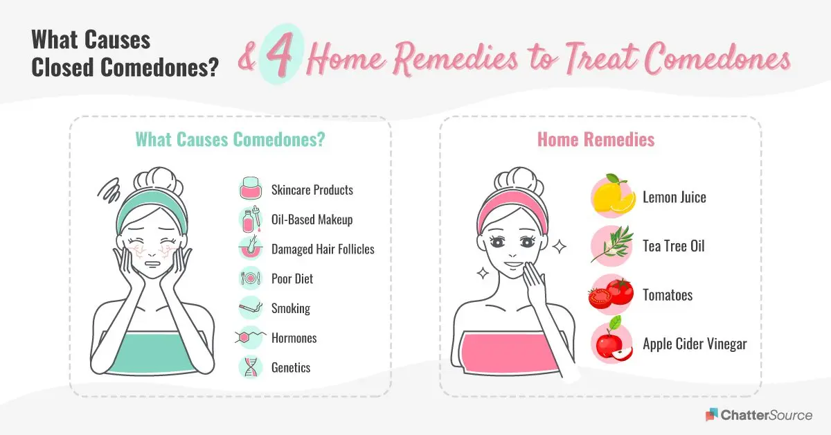 Remedies for comedones: what will help get rid of blackheads forever