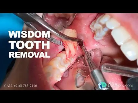 Removal of a wisdom tooth. Video