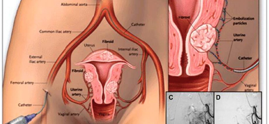 Removal of fibroids during pregnancy: how pregnancy proceeds after removal of fibroids